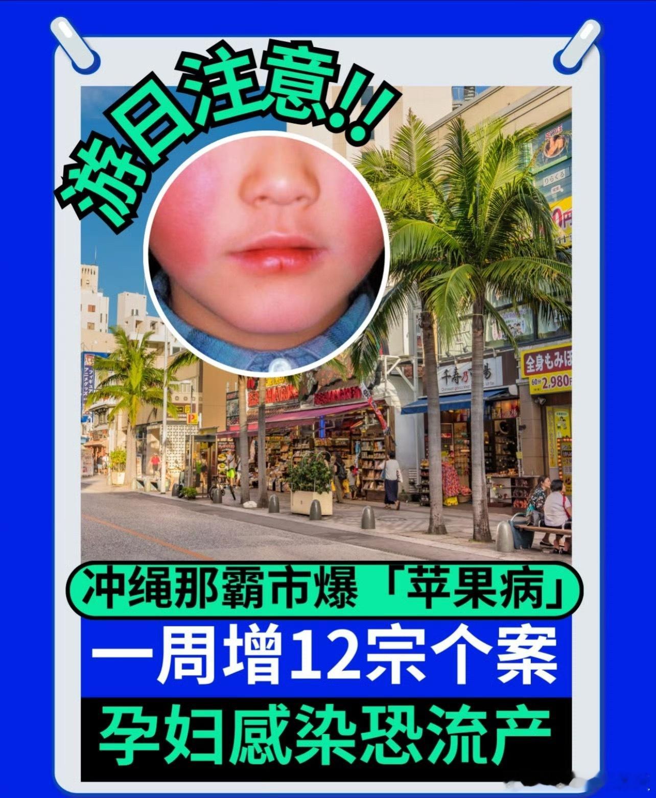 日本 苹果病 日本近期出现可传染性“苹果病”，初期症状类似感冒容易被忽视，但可通