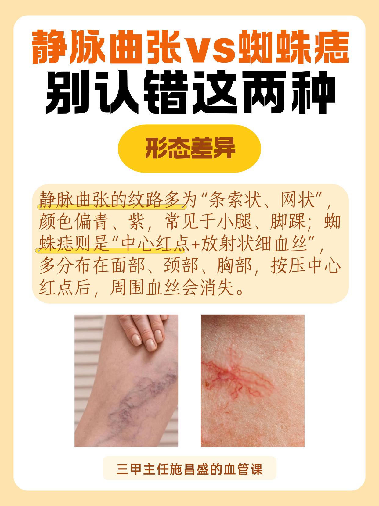 别再认错静脉曲张和蜘蛛痣。静脉曲张和蜘蛛痣看似很相像，但是大有不同
