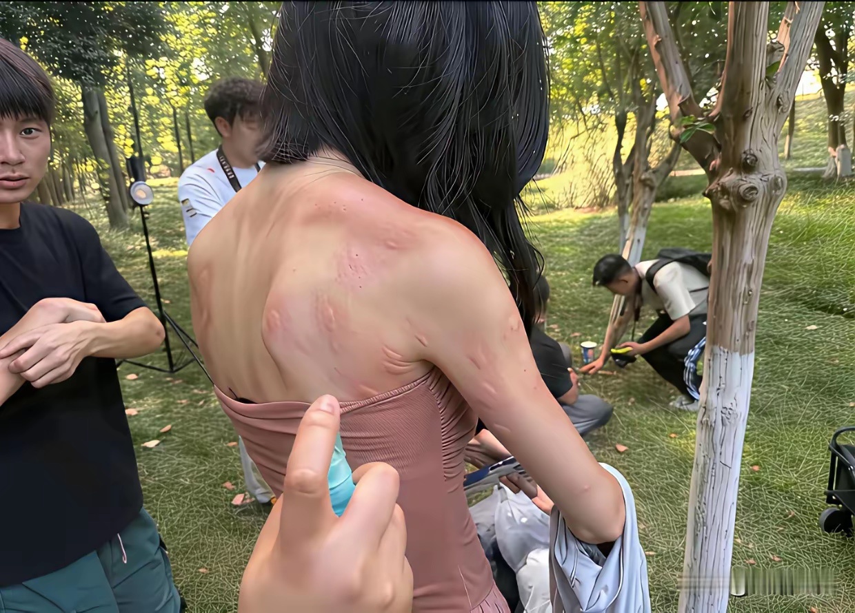这蚊子真的下得去嘴，把一个很漂亮的小姑娘咬的全身都是小疙瘩，这也太吓人了吧。 