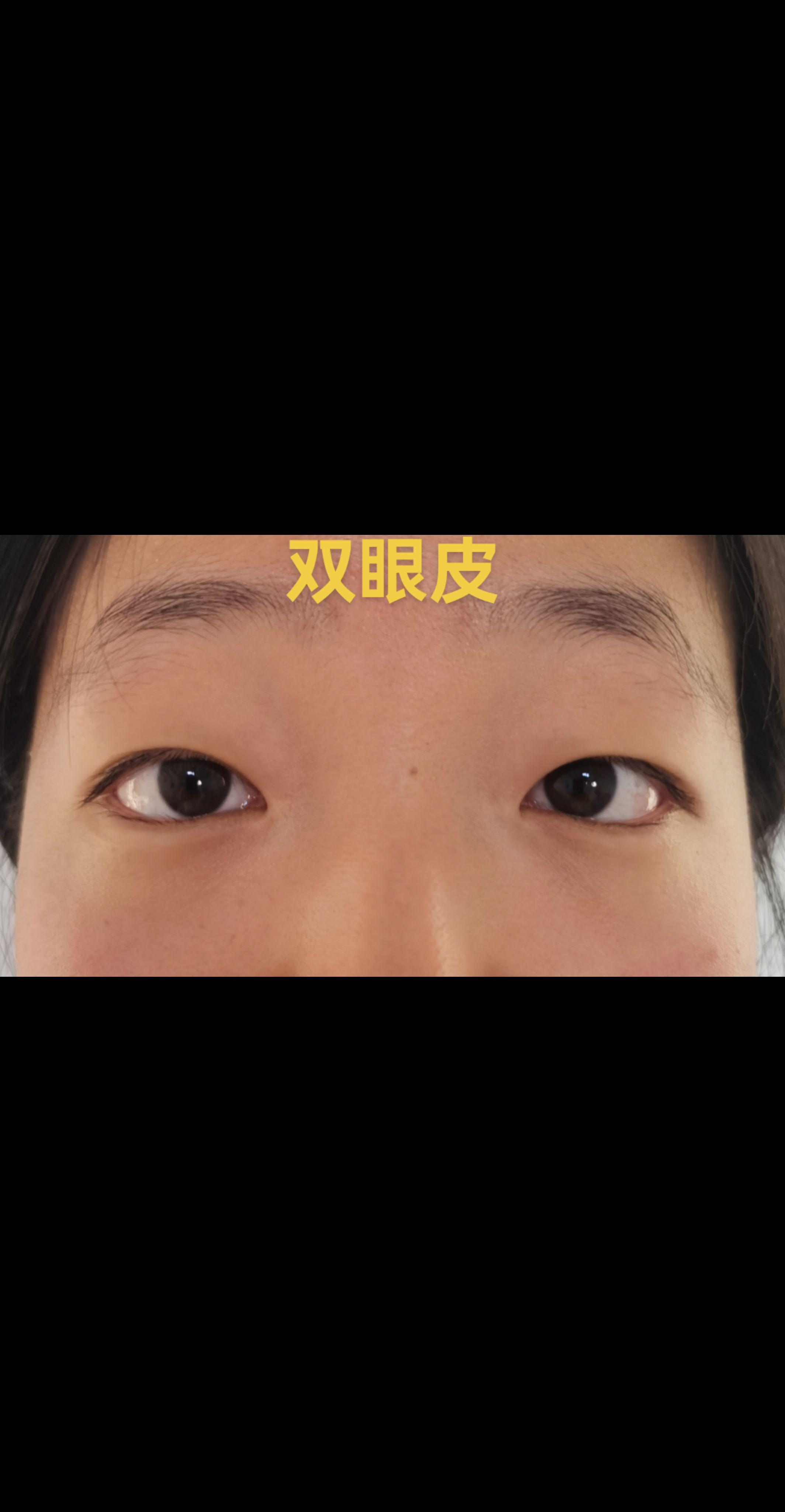 双眼皮。开扇型双眼皮。