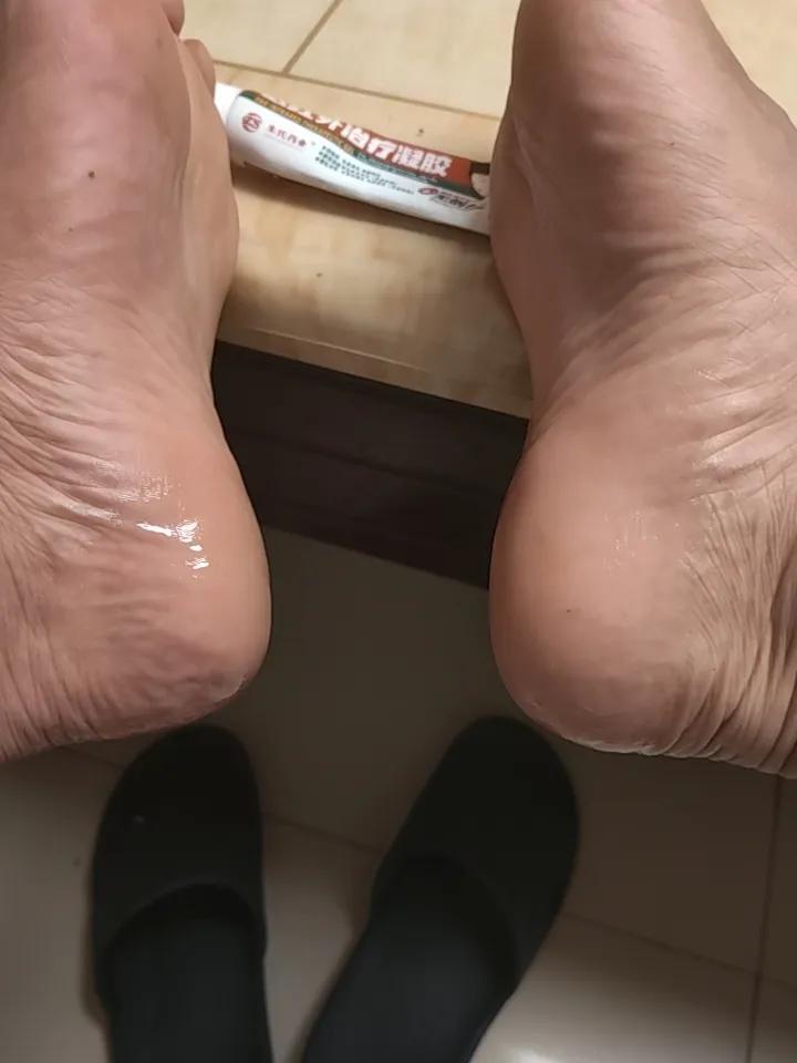 研究脚后跟疼，前景非常好，因为得此病的人很多。友友们，治疗脚后跟疼用这个胶，你们