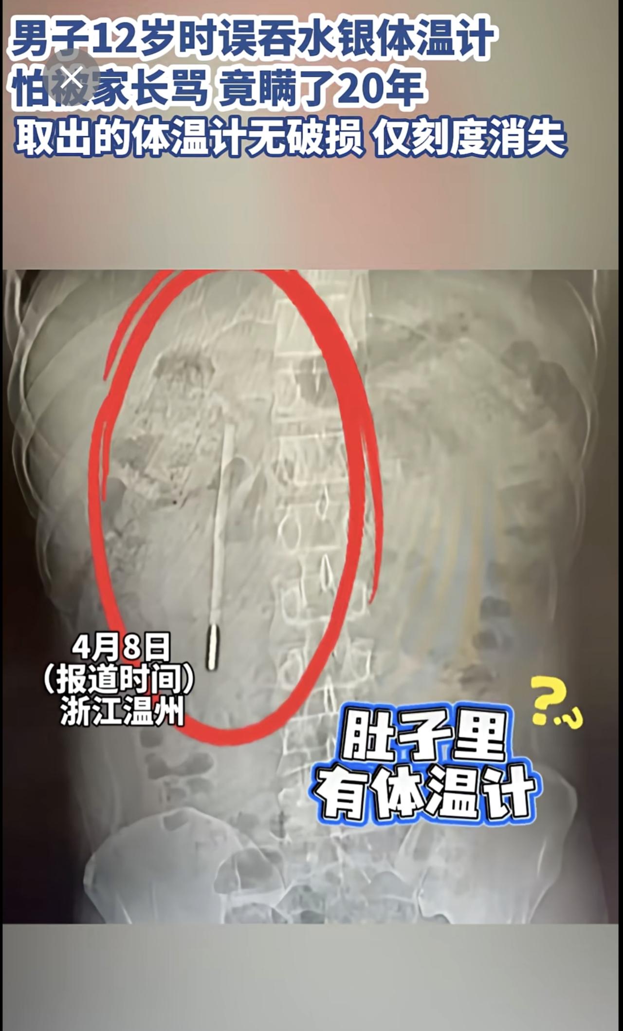 男子12岁时误吞水银体温计，怕被家长骂 竟瞒了20年，取出的体温计无破损 仅刻度
