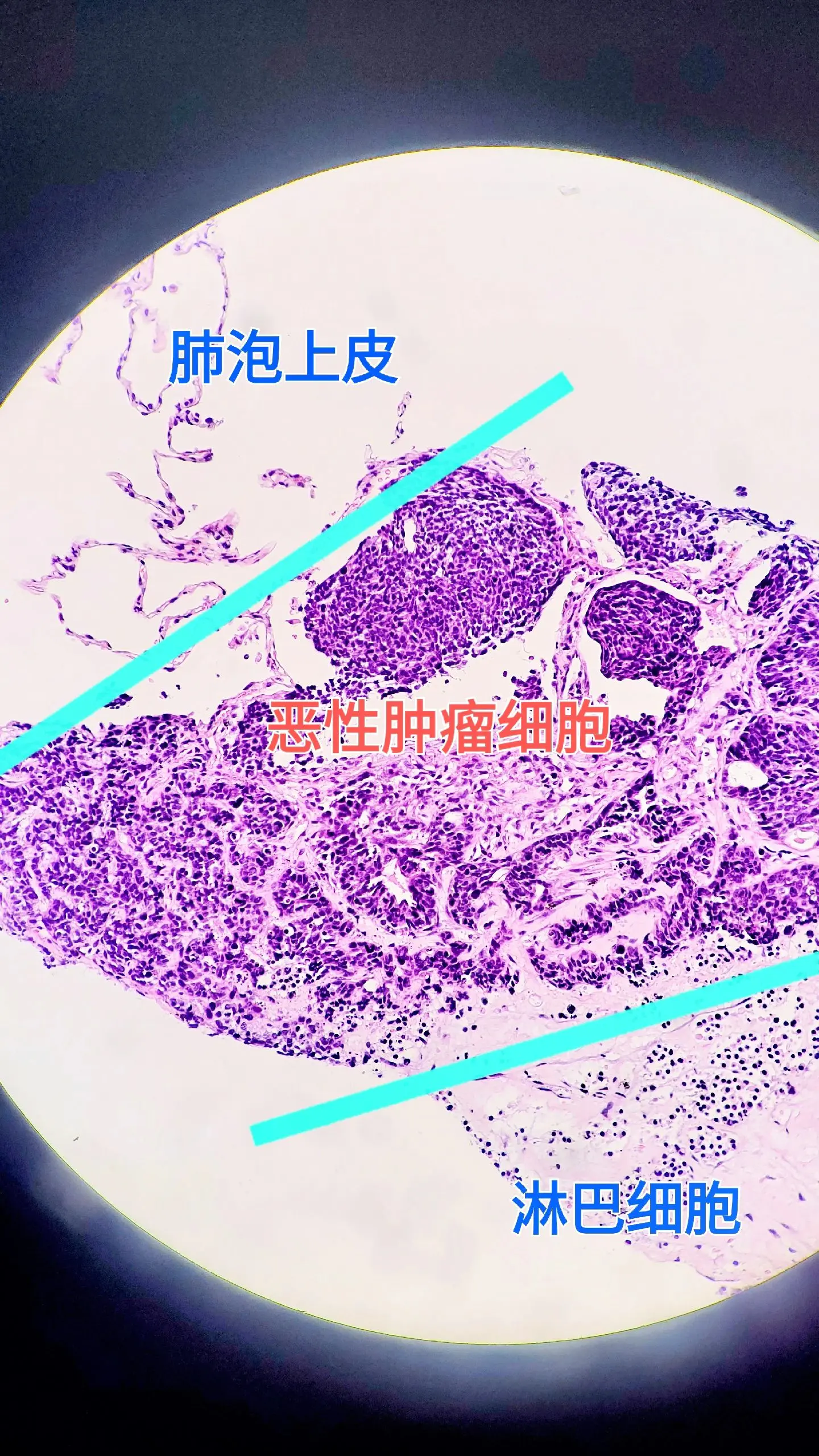 肺小细胞癌