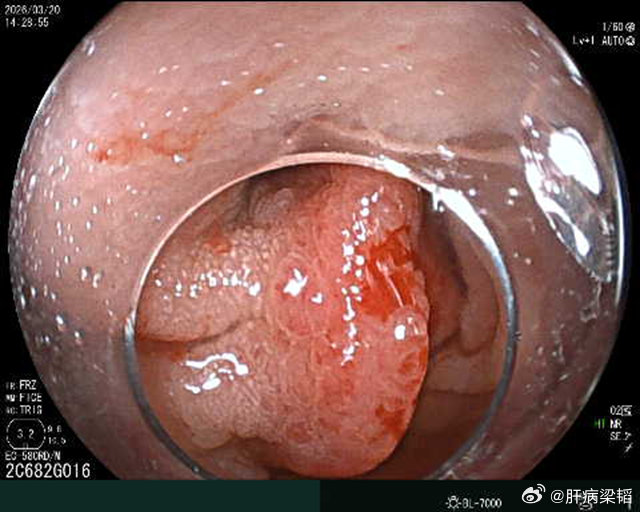 短宽蒂还是要谨慎，特别是大于1/3周的，内镜治疗的最终目标是为了患者的远期获益。