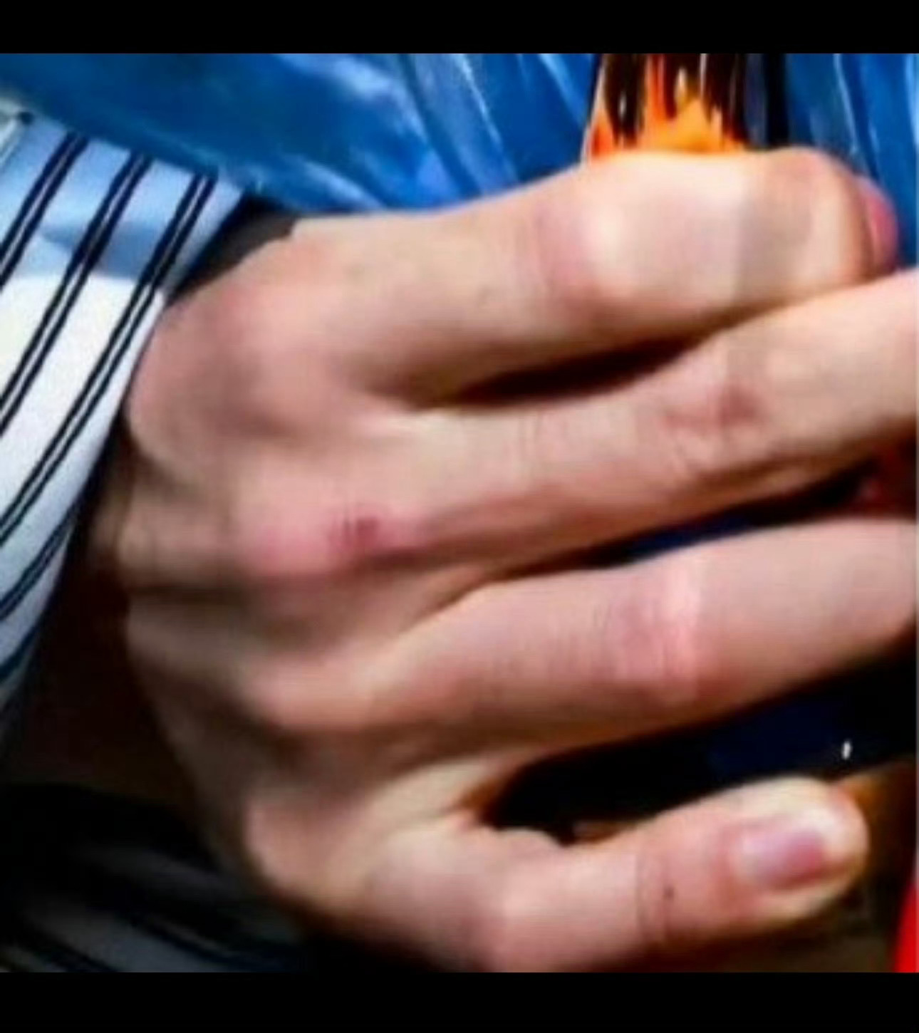 看到热搜吓死了赶紧点进去看嗝嗝的手到底怎么了看到照片后我直接吓哭了！ 居然这么大