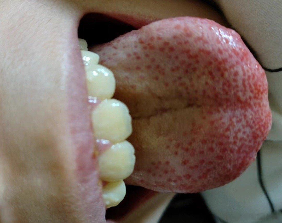 晚上师妹跟我聊天，说一个小孩高烧，本来舌苔厚腻，艾灸后出现这种草莓舌。肺主一身之