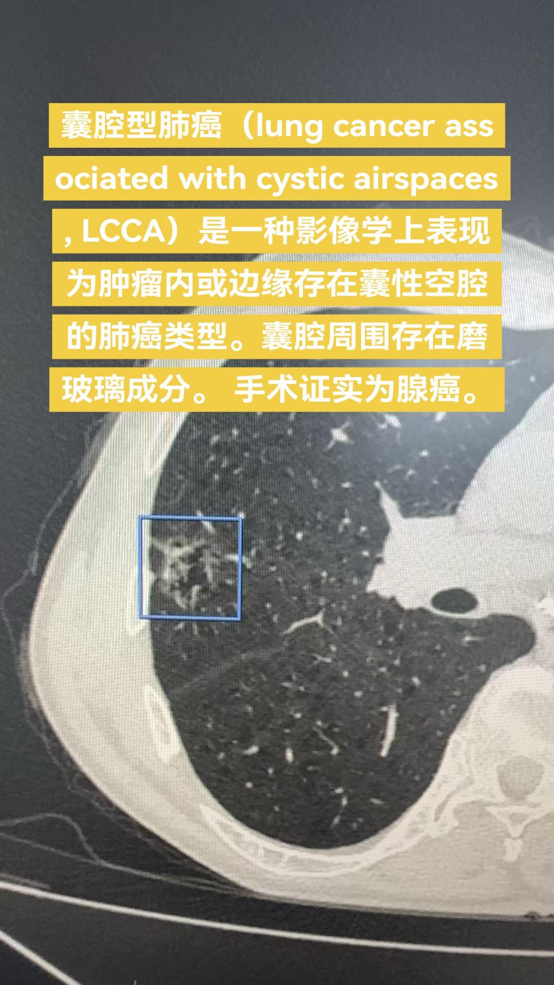 囊腔型肺癌……囊腔型肺癌（lung cancer associated...