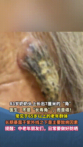 “真是活久见！”浙江义乌，83岁老太因常常出门晒太阳，结果左边太阳穴居然长出黄豆