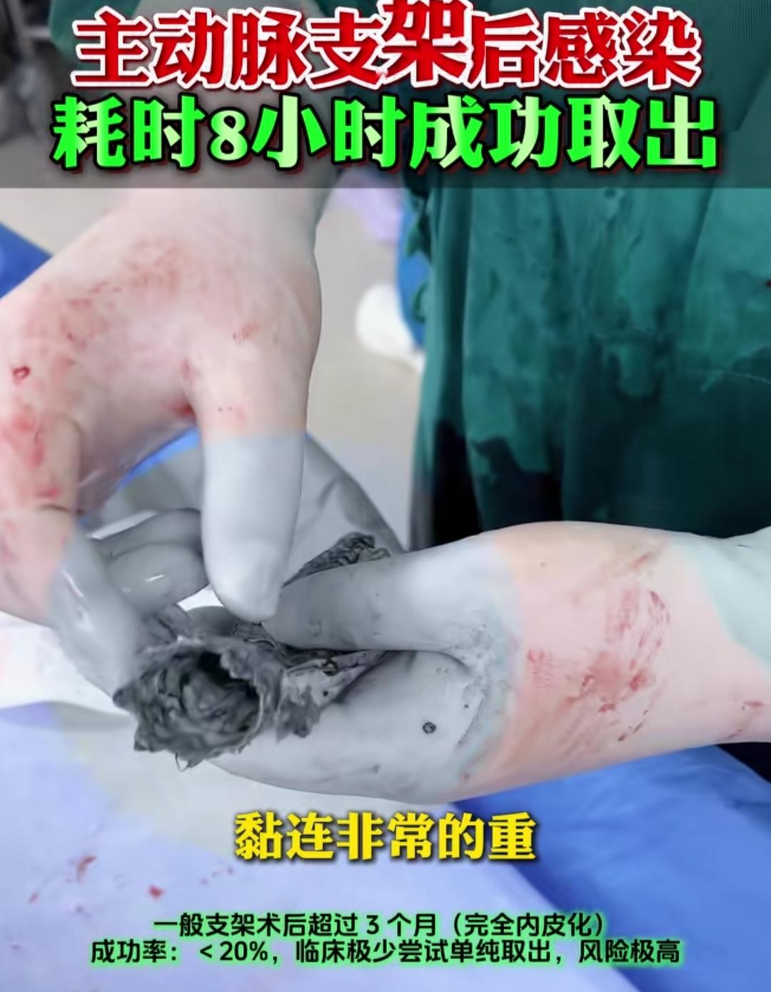 今天才知主动脉支架那么大，放进去也不太容易吧！这么看来，支架植入手术也存在很大的