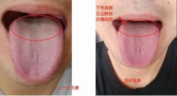 男人别一“功能不行”就去补肾，厚腻苔解决了，功能自然也就强了

患者：肾虚，功能