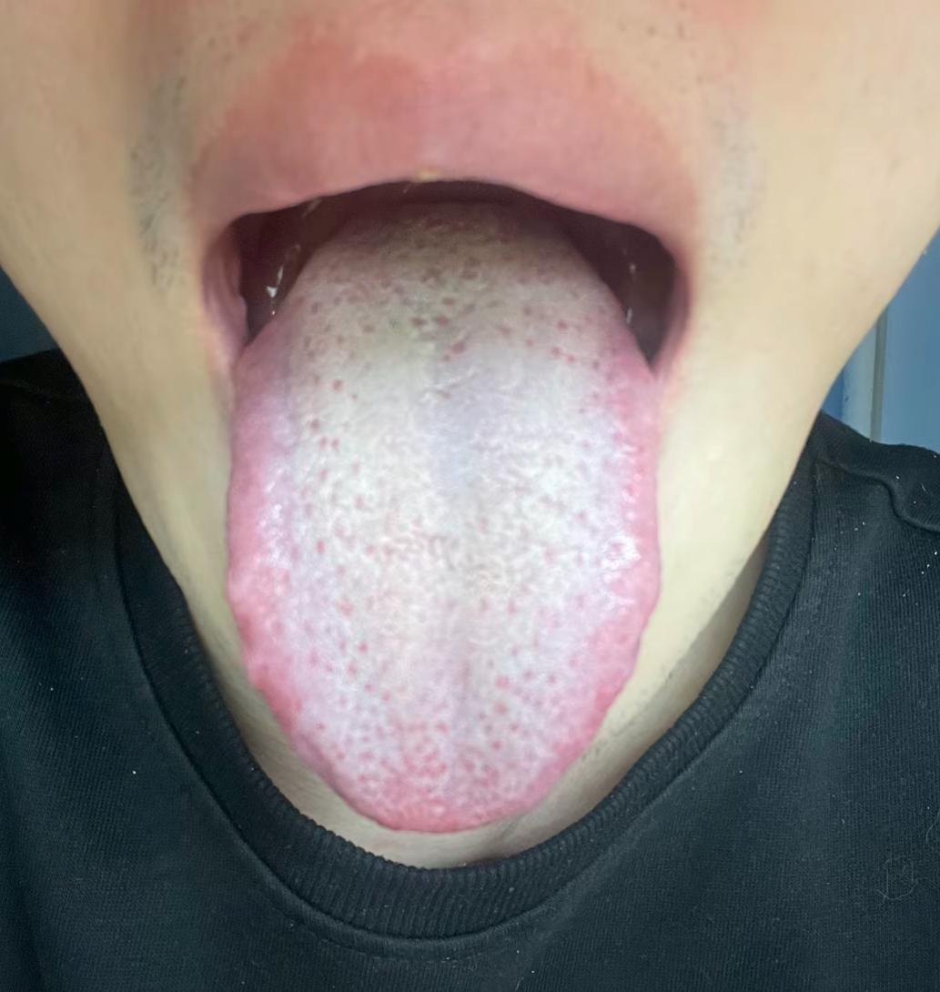 最近发现这种舌象，总是陷入补肾盲区[捂脸]
舌面盖了一层黄腻苔，而且舌根格外明显