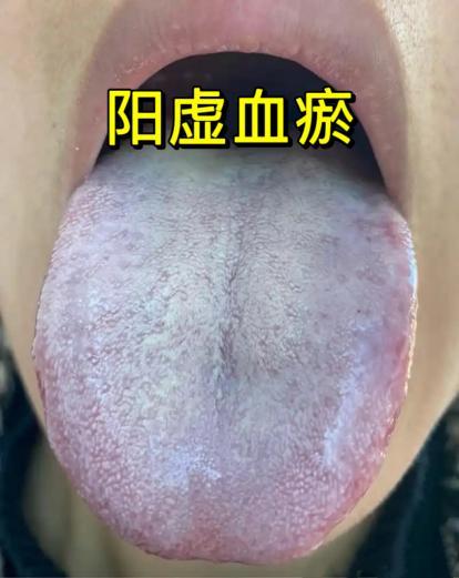 少腹逐瘀丸对应的“血瘀寒凝症”舌象及辨证解析
中医认为“血得温则行，得寒则凝”，