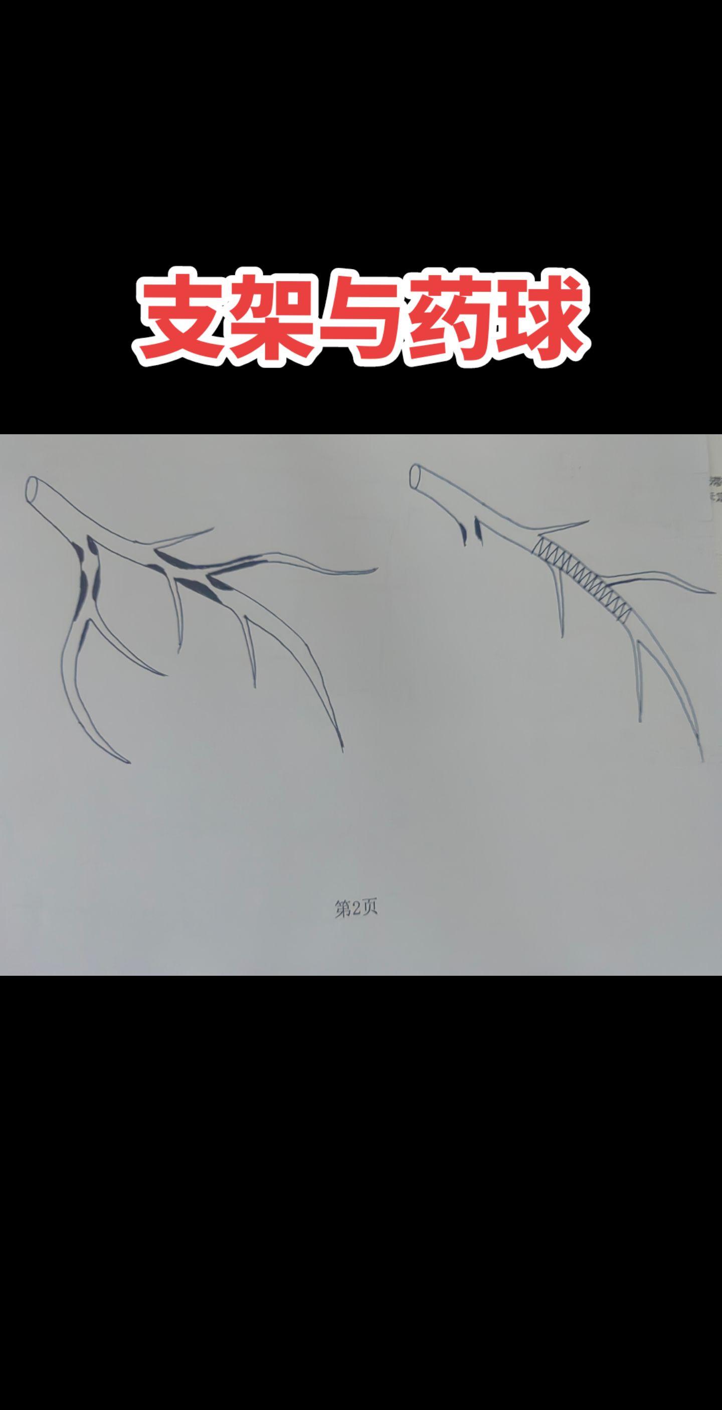 心绞痛，介入治疗后
