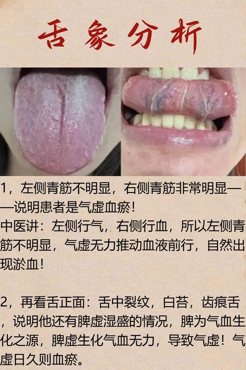 【舌诊分析】舌下青筋粗可别着急化瘀，这个问题不解决，只会越化越严重！
#舌诊##