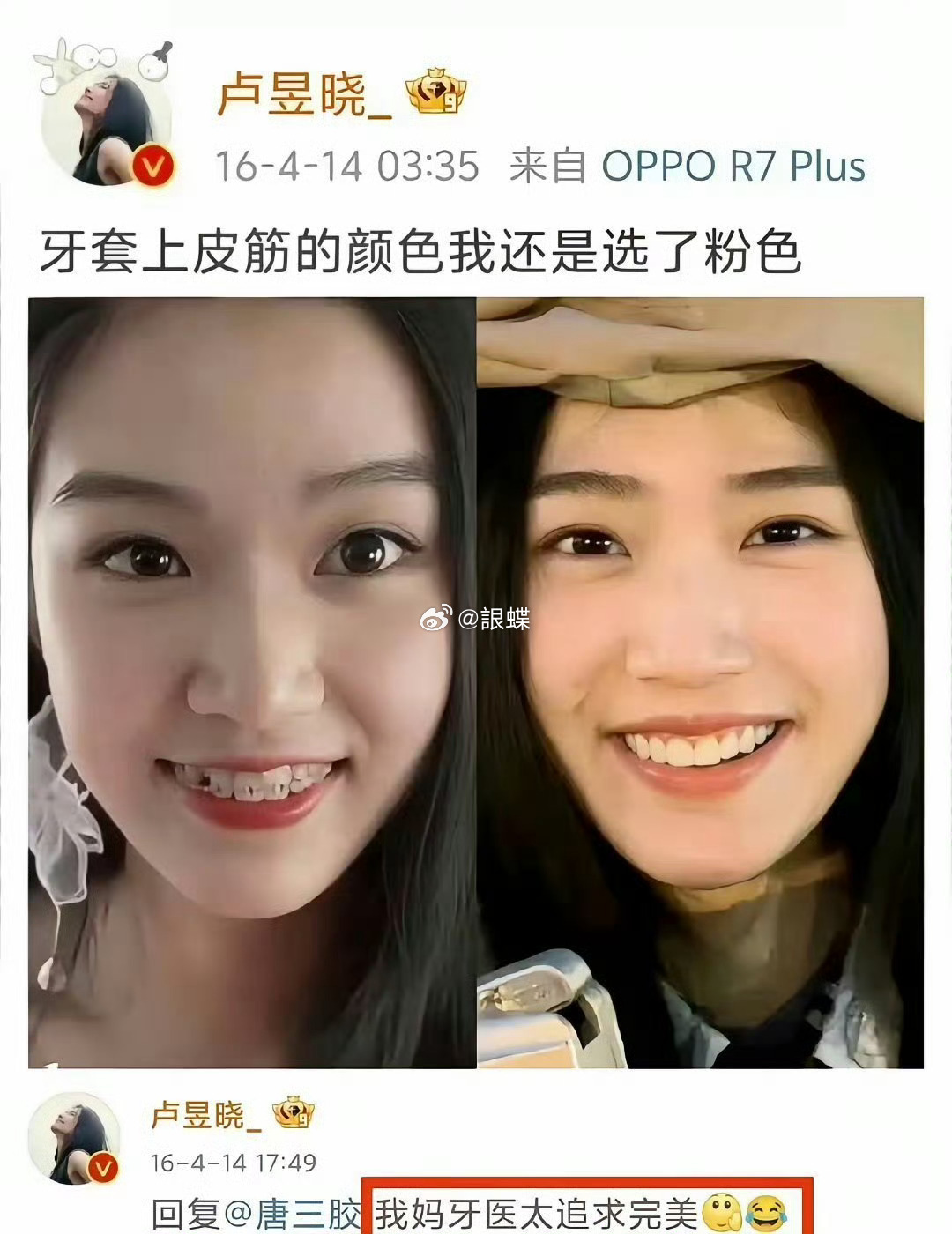 卢昱晓 关于矫正牙齿的重要性 