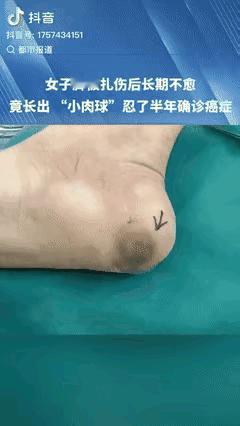 悲剧还是发生了！浙江杭州，一女子前往工地干活，不幸脚底扎伤。起初，女子并未在意，