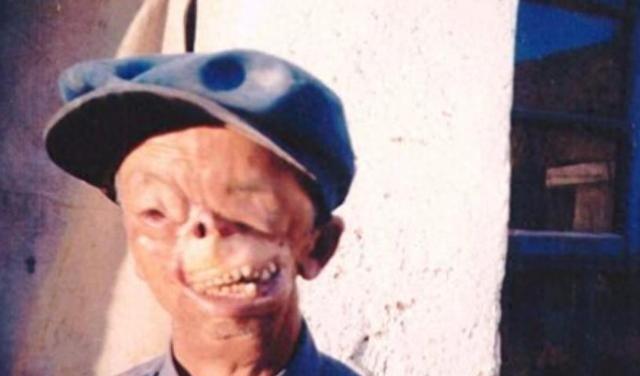 1950年，年仅3岁，就被狼咬掉了半张脸，父亲将其无情的扔到山洞中，没想到他却顽