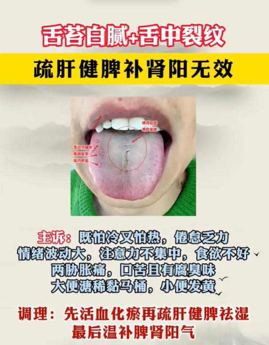舌有裂纹、舌苔白腻，寒热夹杂该如何调理？