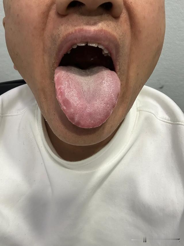 遇上这种舌头是最棘手的，一个不小心就要挨骂[捂脸][捂脸][捂脸]
主诉：胸闷胸