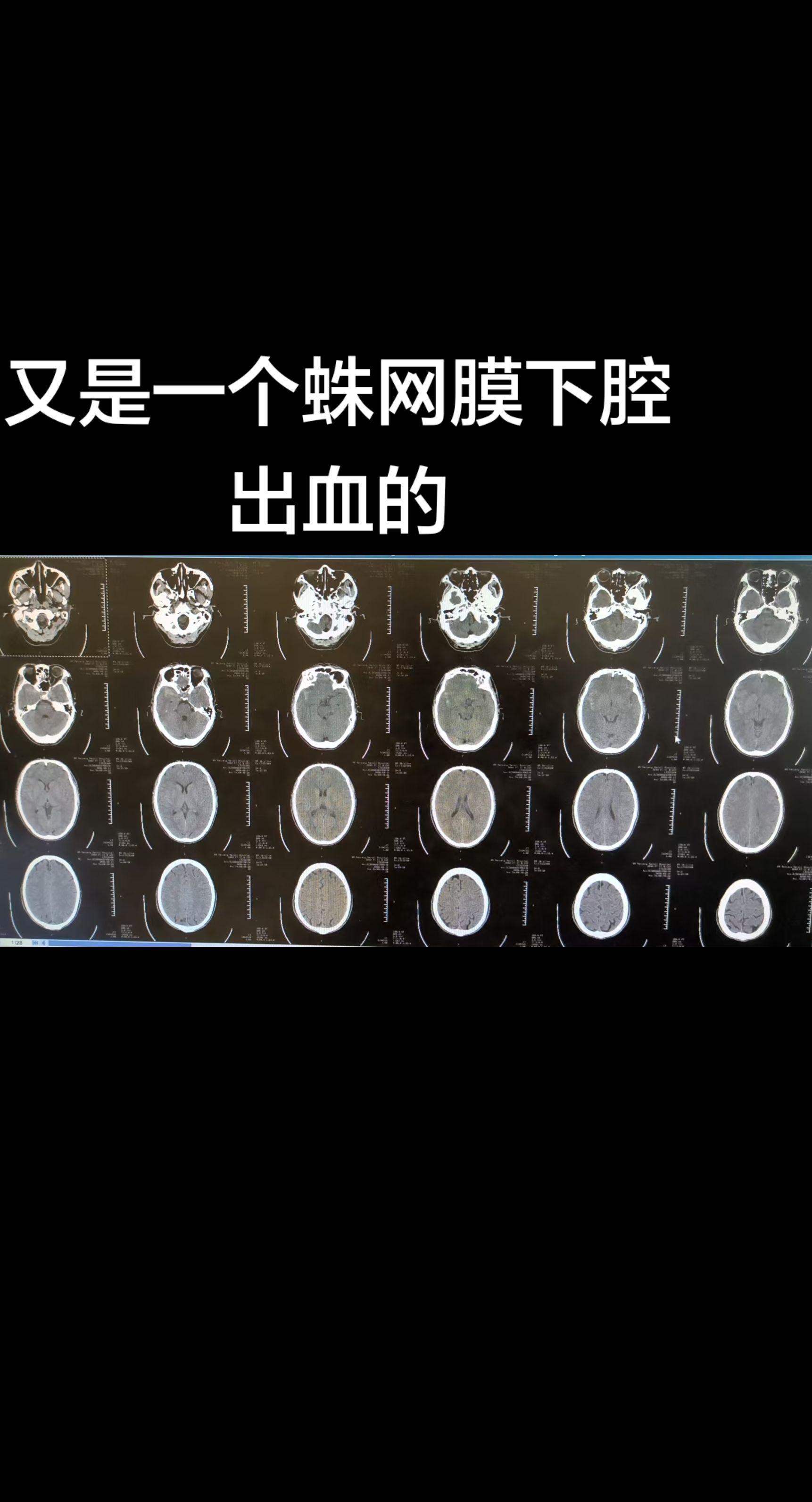 过年期间警惕脑血管疾病高发
