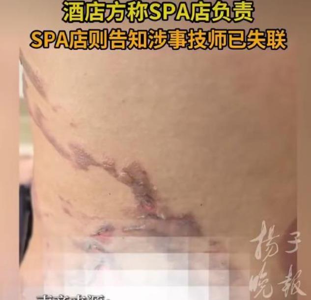 拔罐本来是用来放松解压的养生项目，谁也想不到，在正规酒店里面做理疗，竟然会酿成一