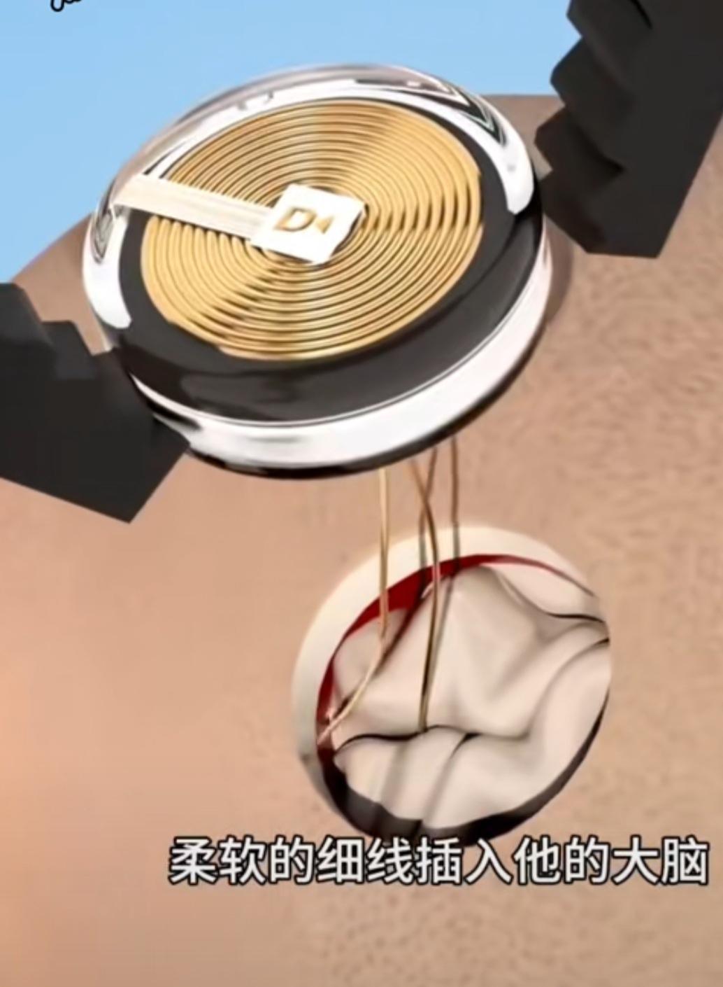 春日生活打卡季比赏花更惊讶的是科技突破，直接用手术联接大脑与网络的手术是真的吗？