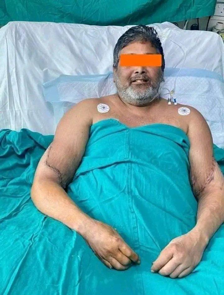 印度医生成功地为一位在火车事故中失去双手的画家实施了一项突破性的手部移植手术。这