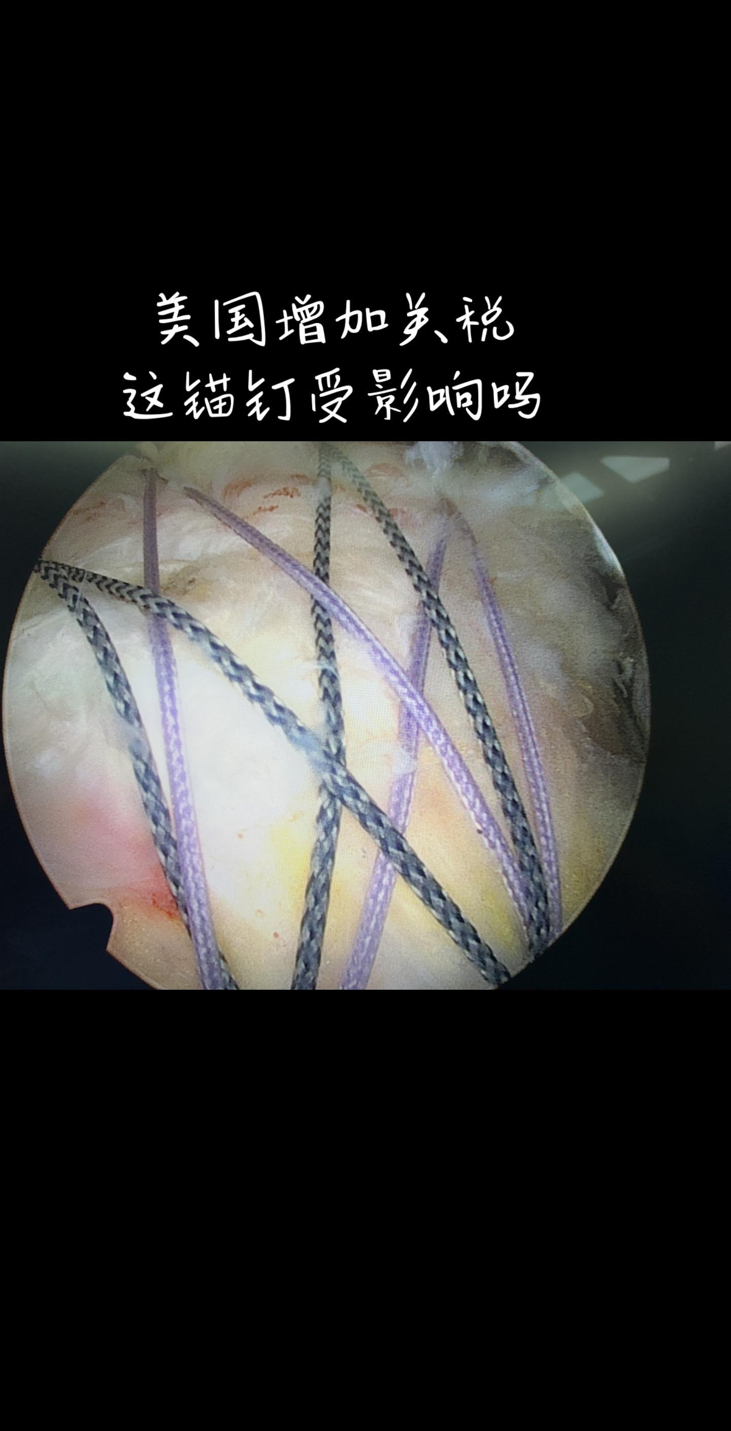 双排缝线桥修复。关税影响吗