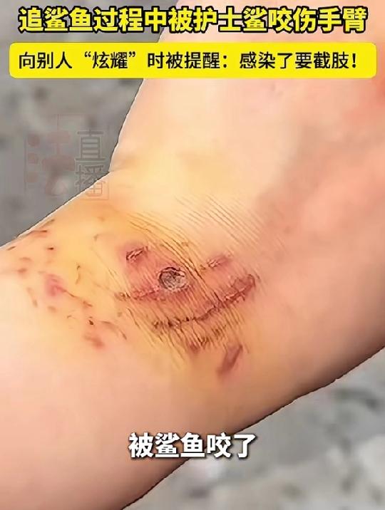 这心也太大了吧！女子生理期潜水被鲨鱼咬伤，向别人炫耀时还哈哈大笑！

刷到一则视