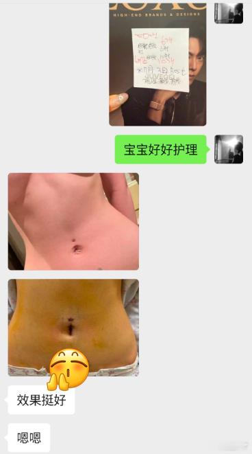 韩国的肚脐眼手术真的满意率超高，局麻下进行一个小时，即刻视觉都能看到线条和变化，