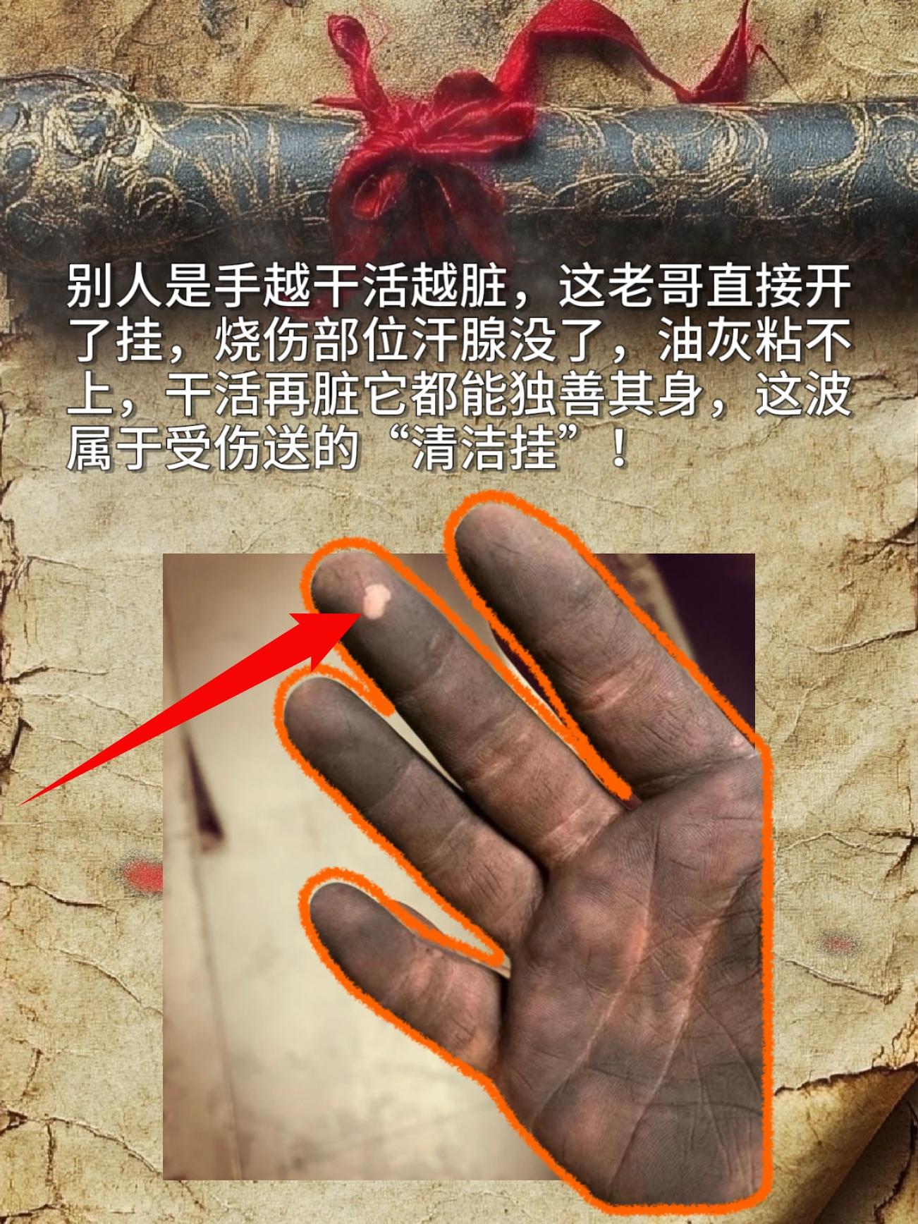 别人是手越干活越脏，这老哥直接开了挂，烧伤部位汗腺没了，油灰粘不上，干...