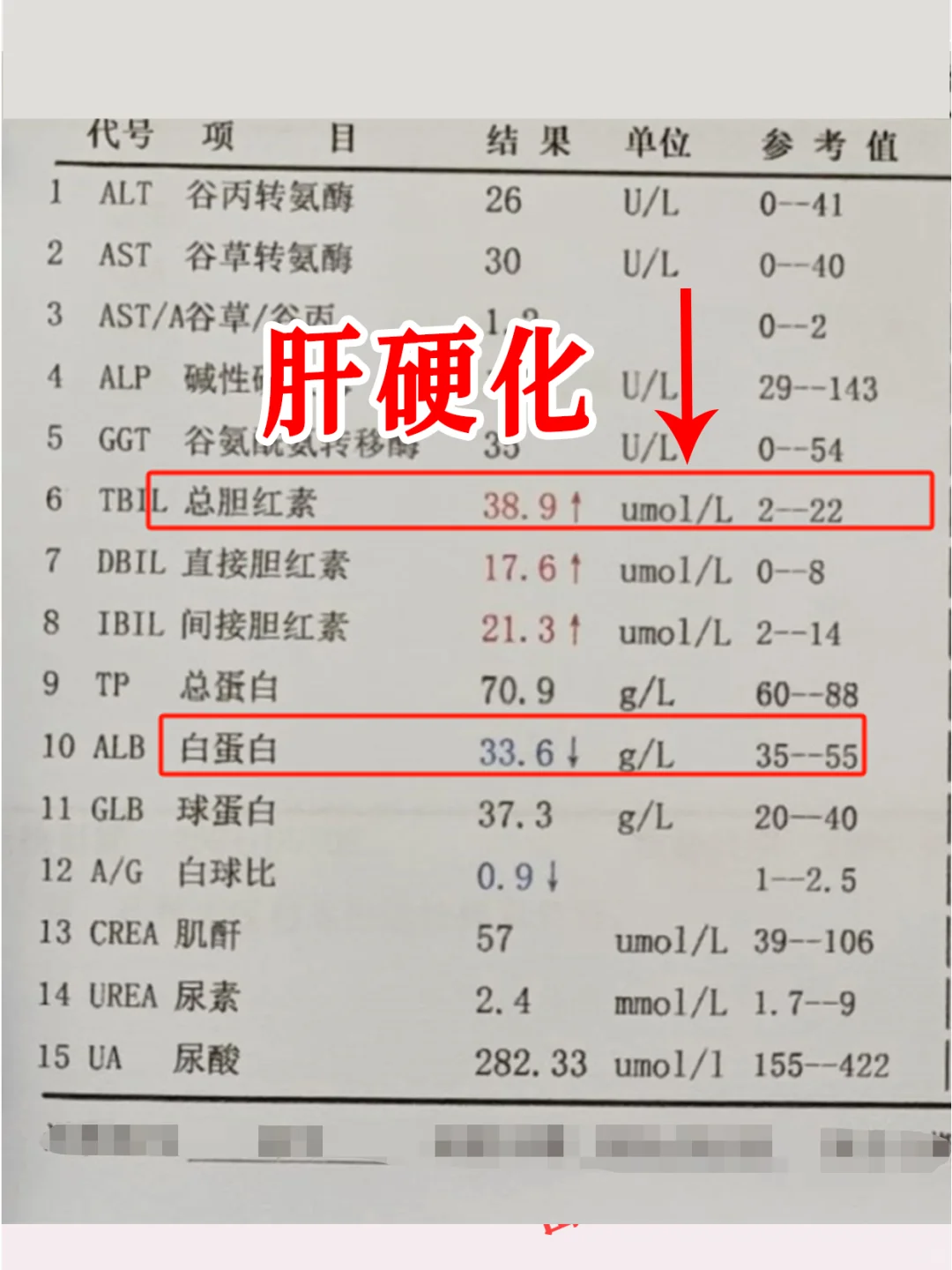 大家看这位山东患者，转氨酶正常却是肝硬化