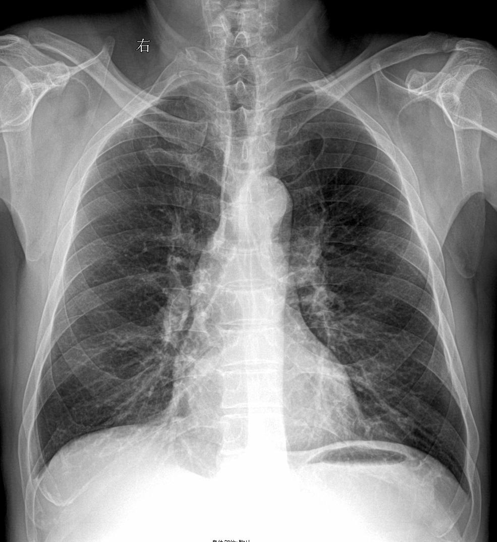 右侧肺门出类圆形高密度影，形态规则，边缘光滑，考虑什么？