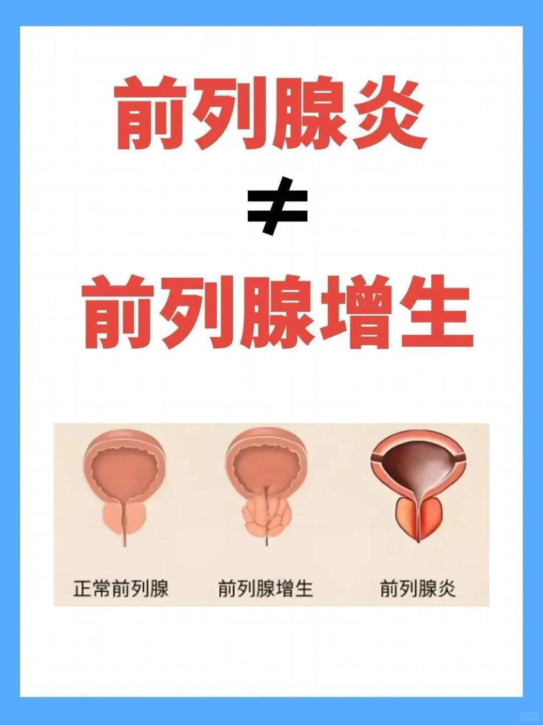 前列腺炎≠前列腺增生