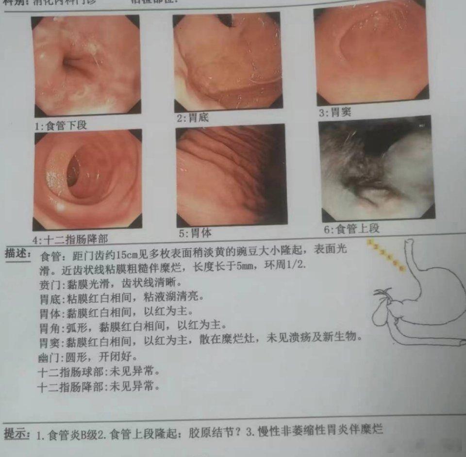 食管胶原结节是一种发生于食管黏膜的良性病变。 其主要特点是食管黏膜固有层内出现由