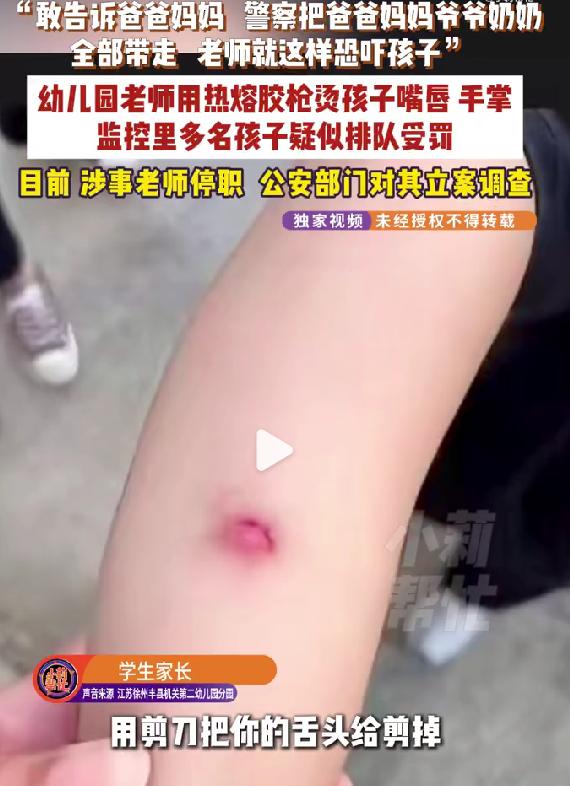 多名幼儿园小朋友被老师用热熔胶烫伤。

这事发生在山东，有家长反映，孩子被老师用