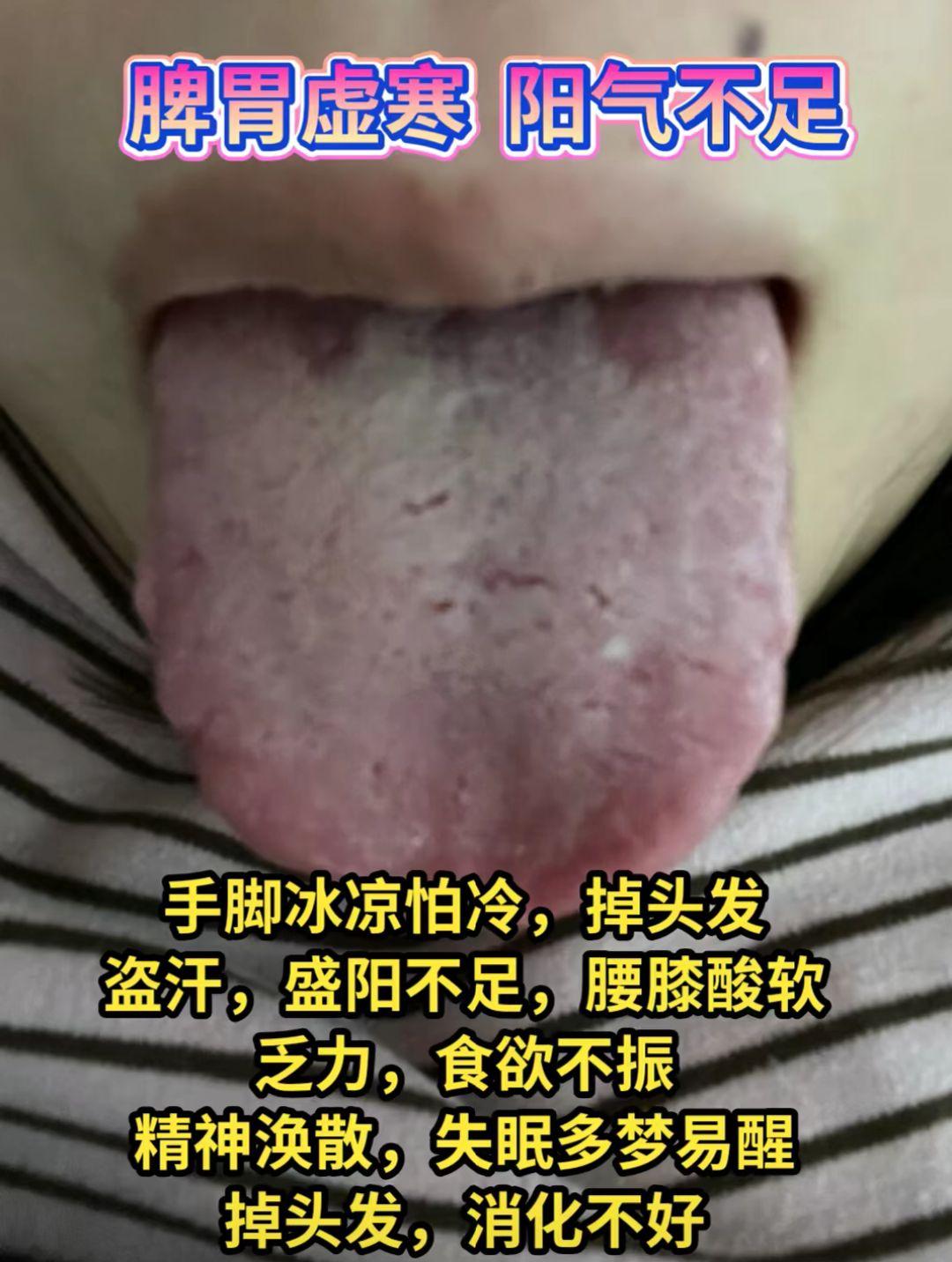 健脾祛湿 疏肝 舌象分析