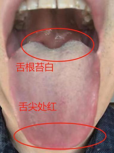 典型的上热下寒舌象，都这个样子了还单纯的补阳，就大错特错了，越清越严重

患者主