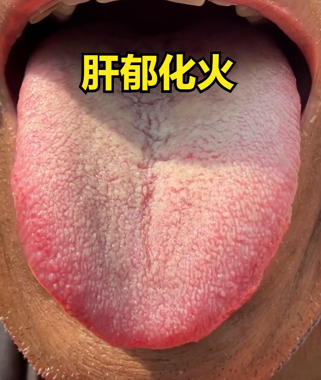 舌边鼓胀发红、易发脾气、眼睛干涩，正是肝郁化火的典型信号，而丹栀逍遥丸确实是针对