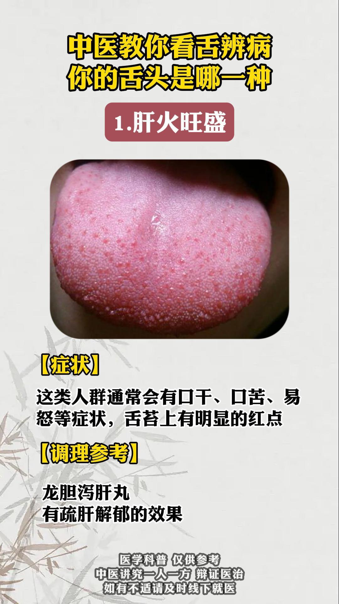 中医教你看舌辨病，你的舌头是哪一种