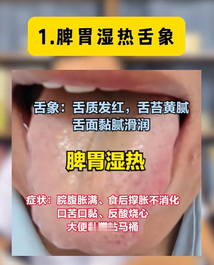 六种湿热舌象自查，分清脏腑再调理