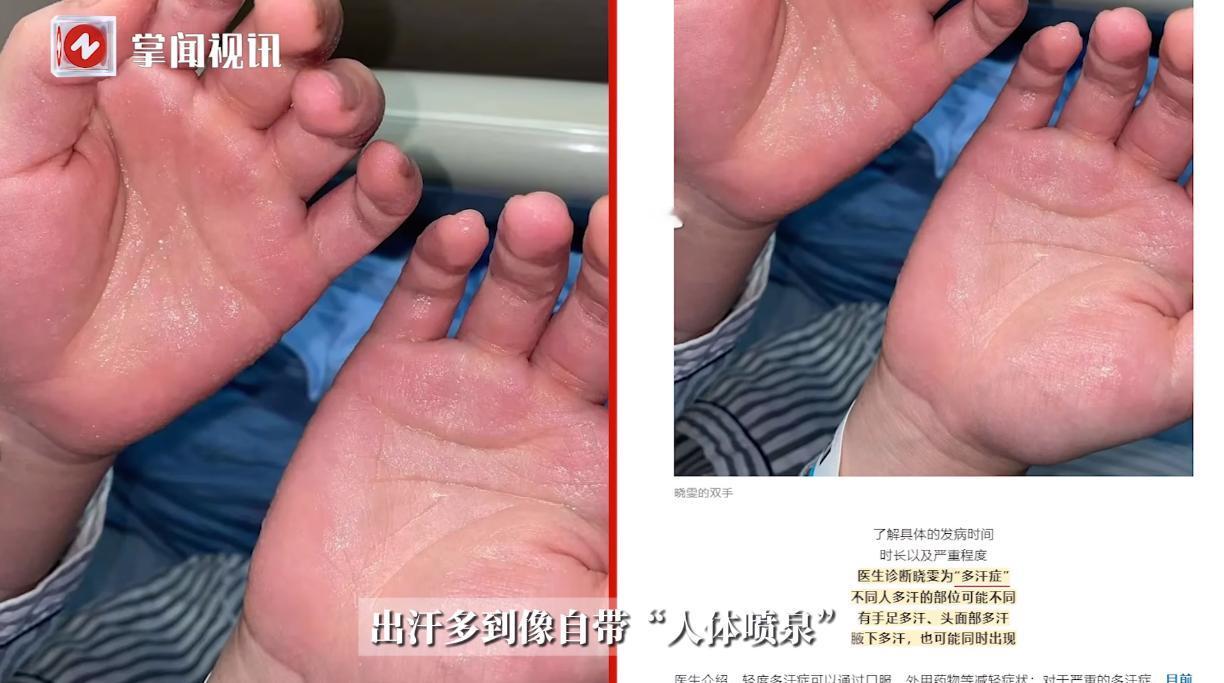 “活久见！”浙江杭州，一女子自从12岁的时候，就开始手脚不自然的出汗，如同随身带
