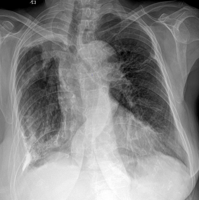 胸闷气短，85岁 女，考虑什么家人们