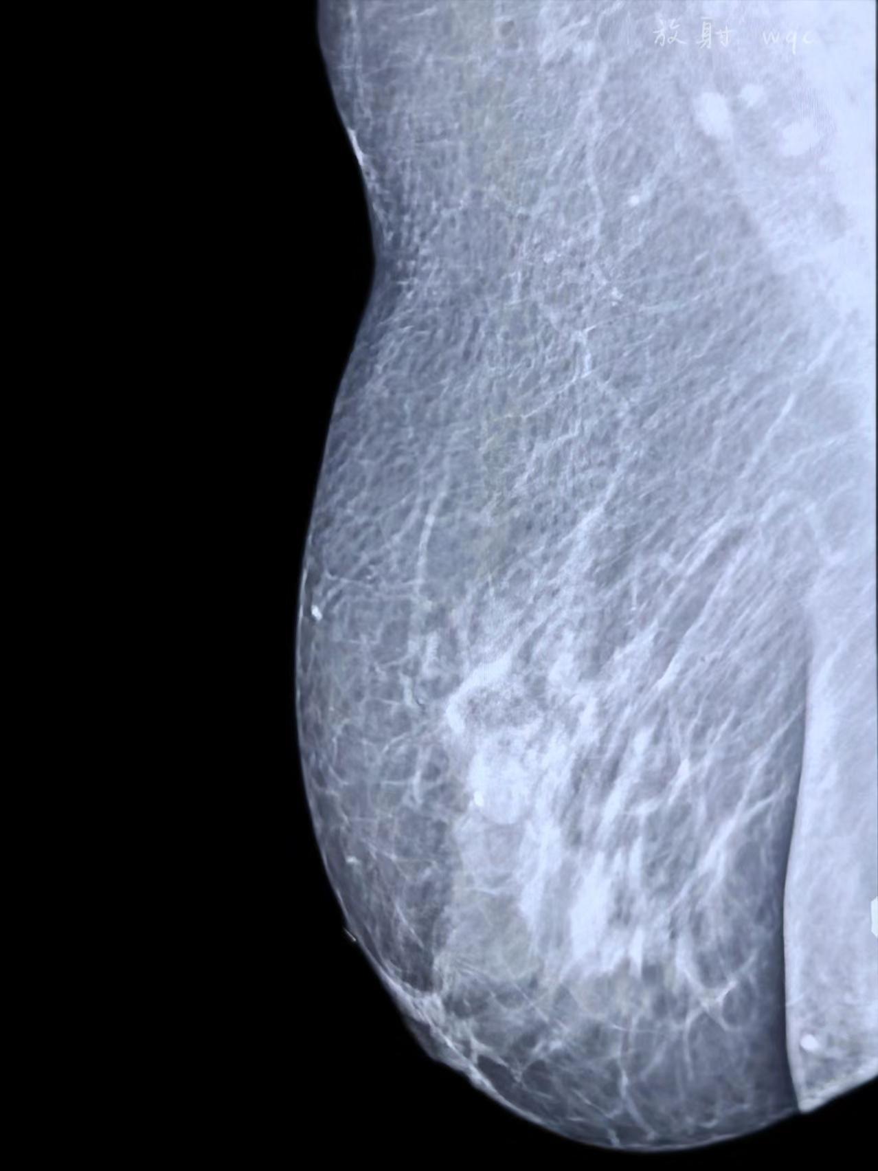 良性还是恶性？