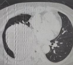 这位60岁男性患者，多年来一直没做过体检。这几年他常觉得胸口发闷，以为是工作累着