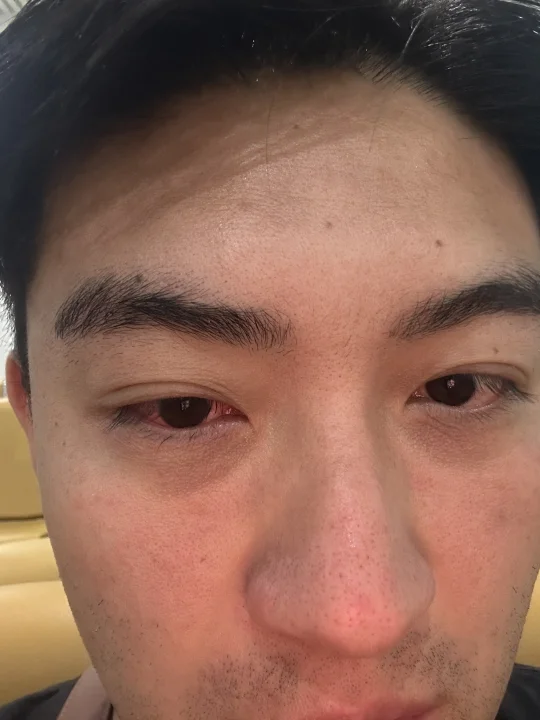 过敏不硬抗｜不单是雷暴 ｜过敏实录