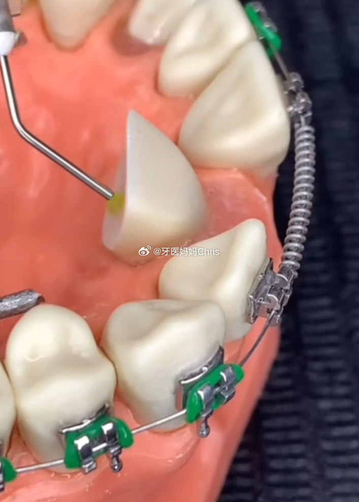 儿童牙齿矫正这个话题，在家长群体中关注度一直比较高。什么时候开始矫正、什么情况需