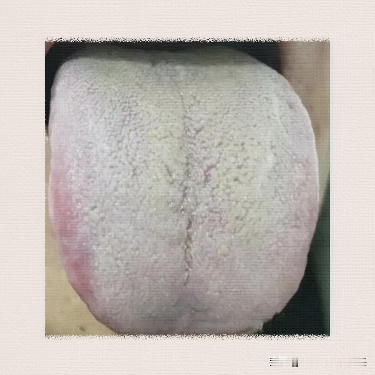 出现这种“积粉苔”，怪不得总是咳嗽咳痰！中医教你一招，把“积粉”给刮干净

这位