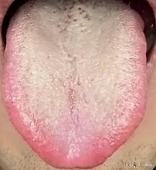 像这种舌象，可不是阴虚，不重视只会越来越严重。

来听听这位患者怎么说：房事不和