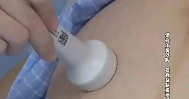 女子怀孕后，胎儿在子宫消失，竟寄生在母亲肝脏上!医生：肝脏妊娠病死率为宫内孕90倍